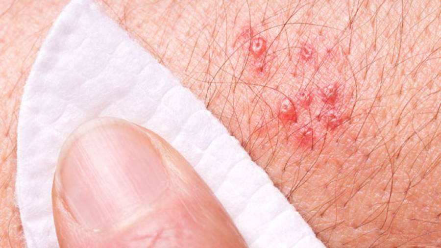 herpes rashes pictures #10