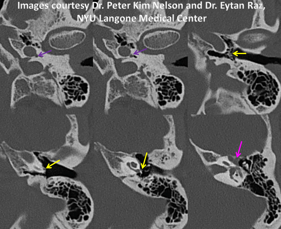 http://www.neuroangio.org/wp-content/uploads/Stapedial_Artery/Stapedial_Artery_10.png