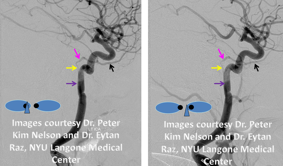 http://www.neuroangio.org/wp-content/uploads/Stapedial_Artery/Stapedial_Artery_4.png