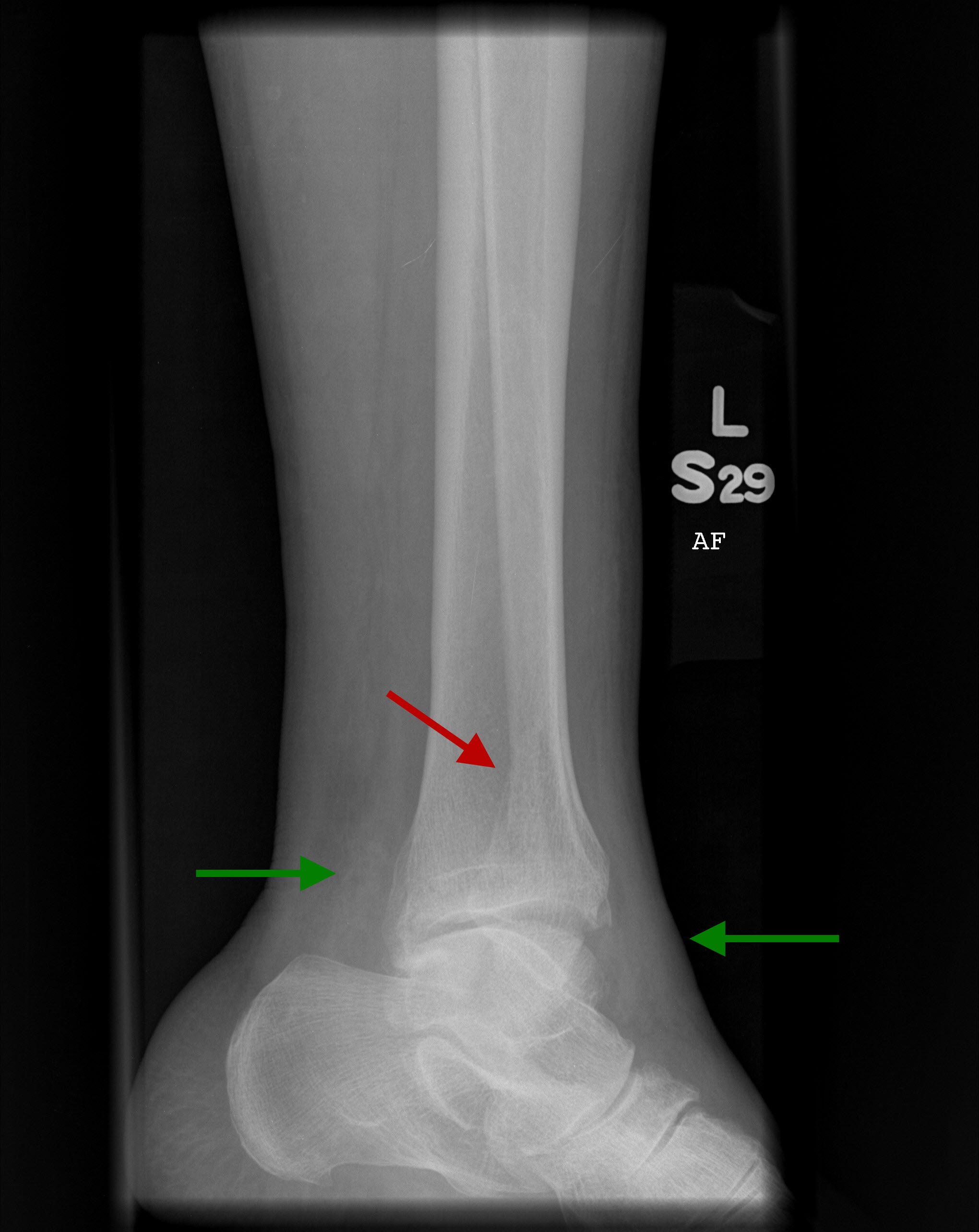 Fibula Spiral Fracture Healing Time - Meryconnections