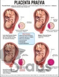 Placenta Praevia