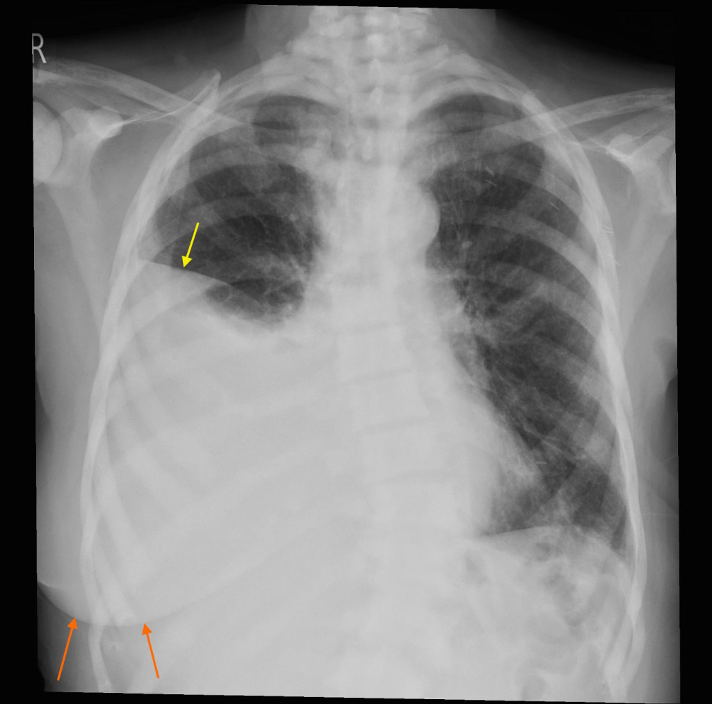 รายการ 98+ ภาพ Pleural Effusion พยาธิสภาพ อัปเดต image.