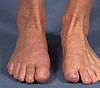 Hallux valgus postoperativ