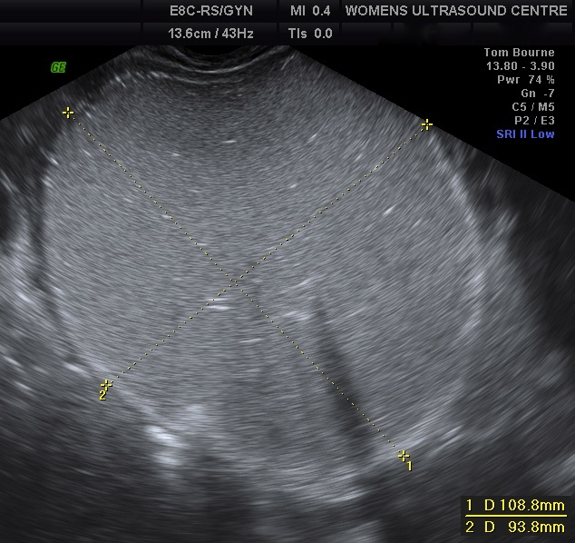 large dermoid cyst