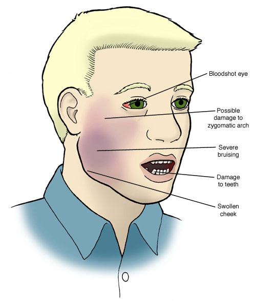 Damaged jaw