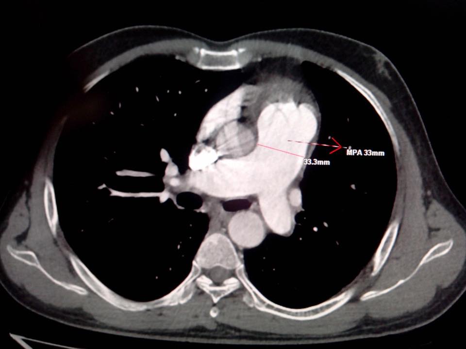 Patent ductus arteriosus-CT - Sumer's Radiology Blog