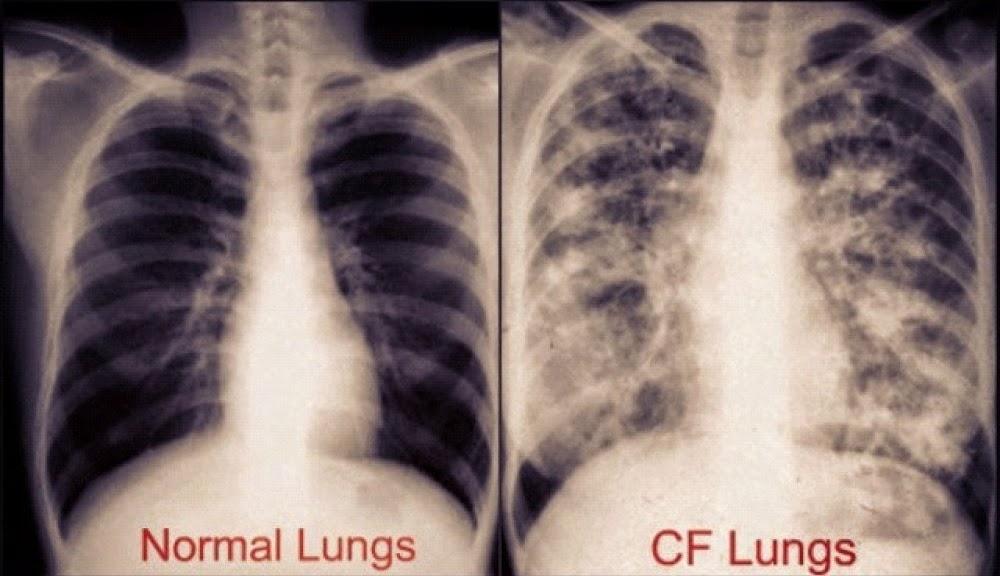 Cystic Fibrosis as related to Goldenseal - Pictures