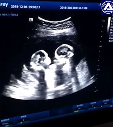 Kitang-Kita sa Ultrasound ang Pag-Aaway ng Kambal na Sanggol na Ito ...