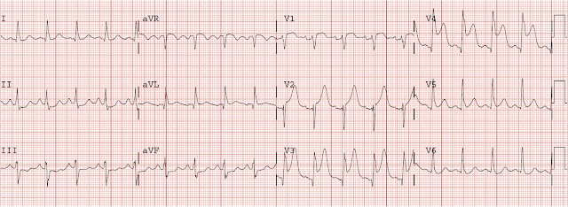 Dr. Smith's ECG Blog: August 2010