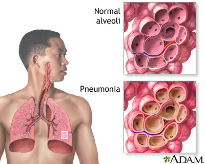 Pneumonia: Symptoms, Causes, Diagnosis and Treatment