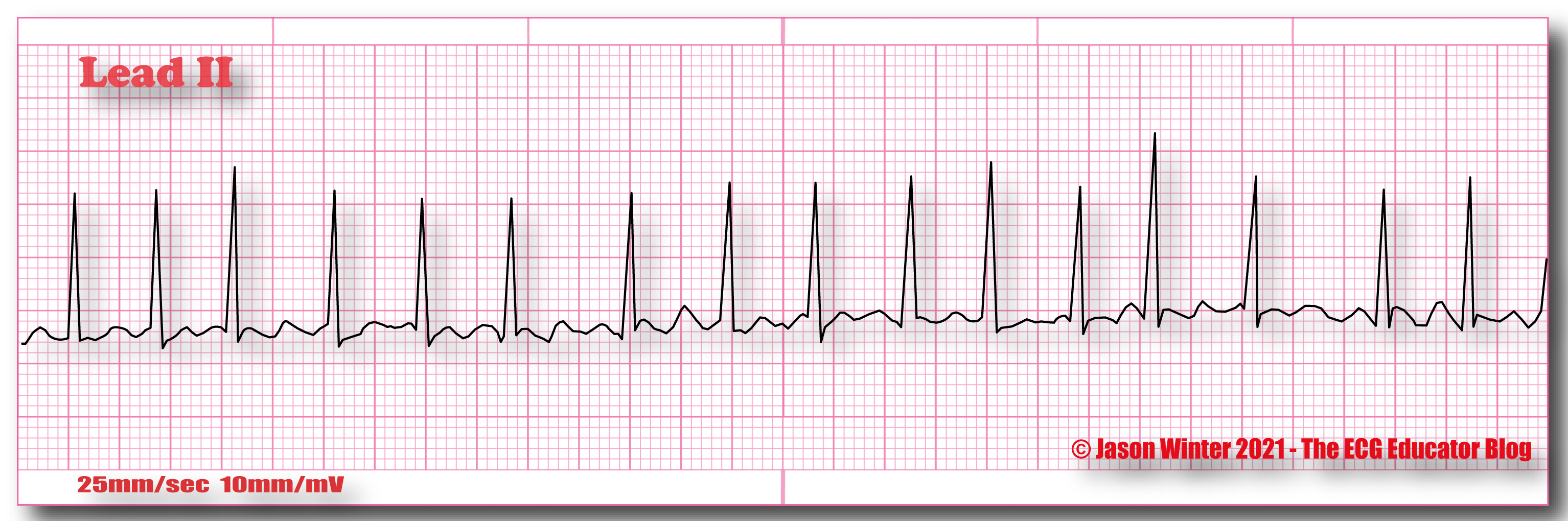 Rapid Atrial Fibrillation Ecg