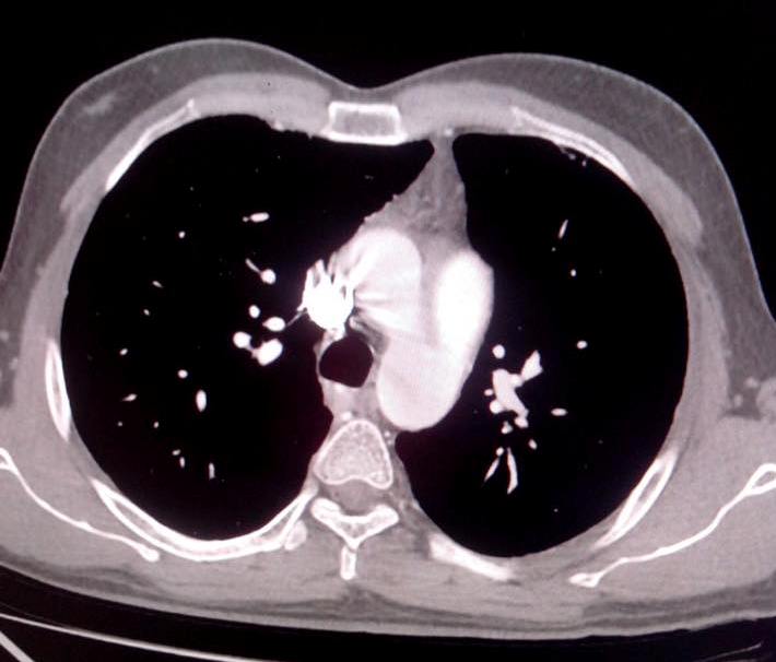 Patent ductus arteriosus-CT - Sumer's Radiology Blog