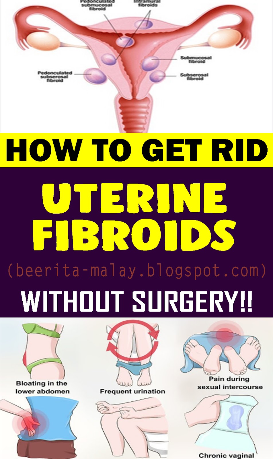 How To Get Rid Uterine Fibroids Without Surgery - BEAUTY HACKS