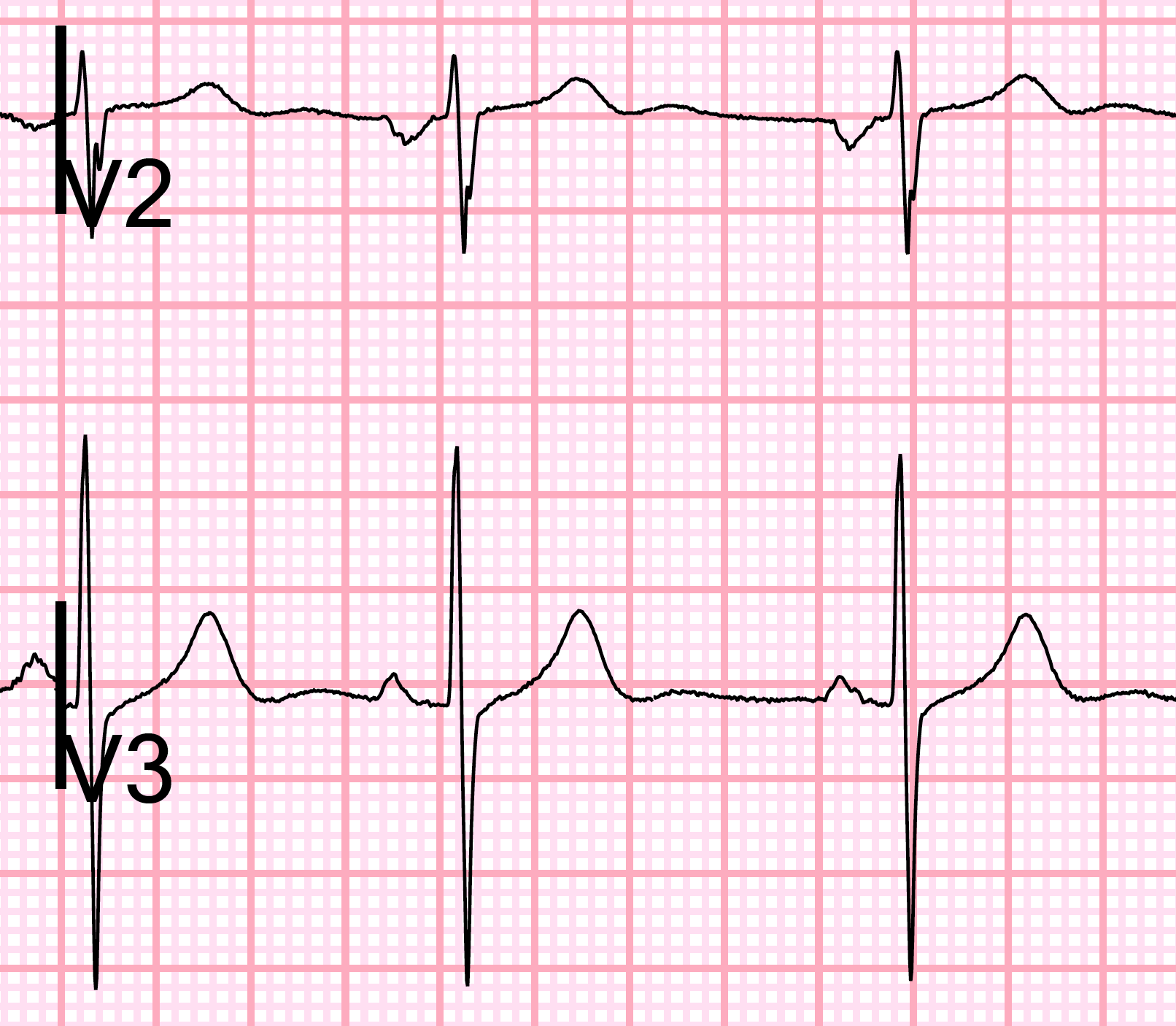 Elevation In V2 Ekg - Image to u