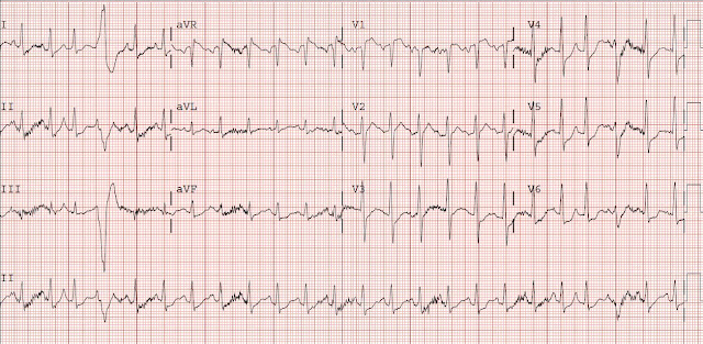 Dr. Smith's ECG Blog: November 2012