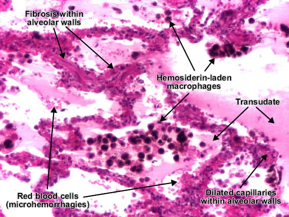 filozofie Danemarca murmurînd chronic pulmonary congestion microscope ... image.