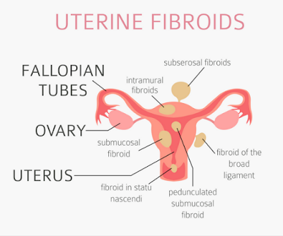 Laparoscopic Surgery: HYSTEROSCOPY