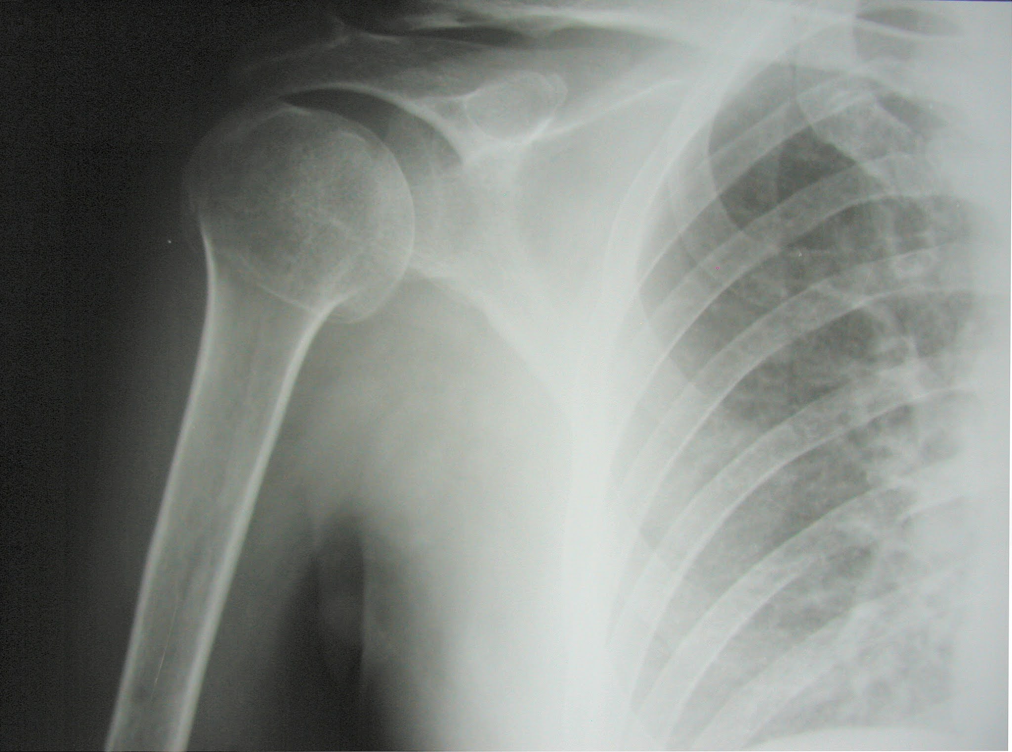 Proximal Humerus Anatomy