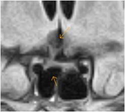 Possible Sheehan's Syndrome - Sumer's Radiology Blog