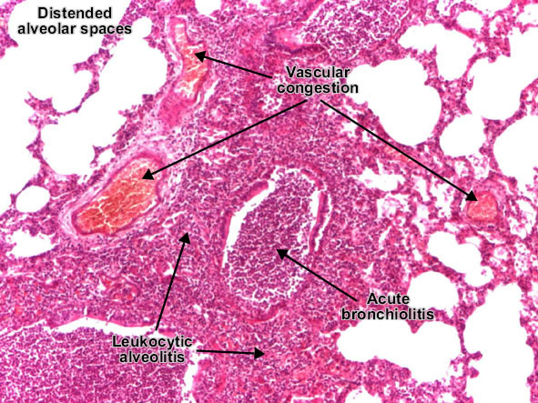 موقع الدكتور أحمد كلحى: صور باثولوجى - Pathology Slides : Pulmonary ...