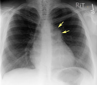 RiT radiology: Pulmonic Valvular Stenosis