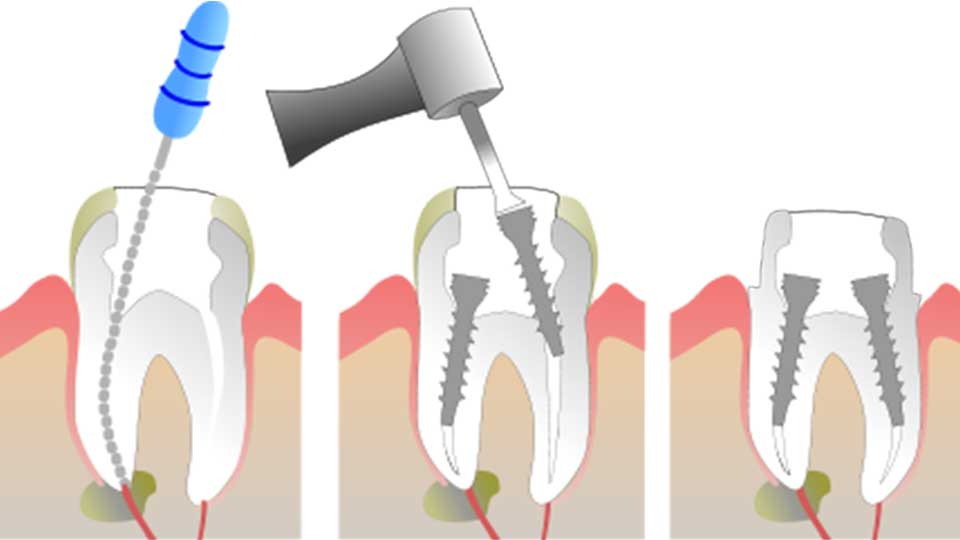 How to Find the Right Root Canal Specialist for Your Needs