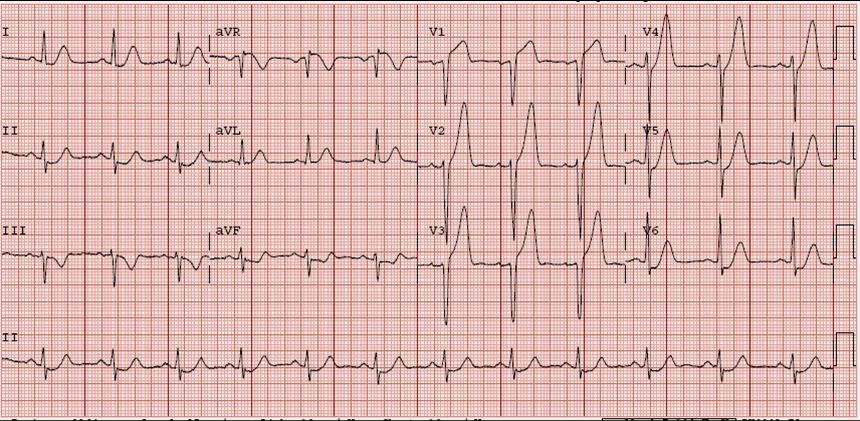 Dr. Smith's ECG Blog: HyperKalemia with Cardiac Arrest. Peaked T waves ...