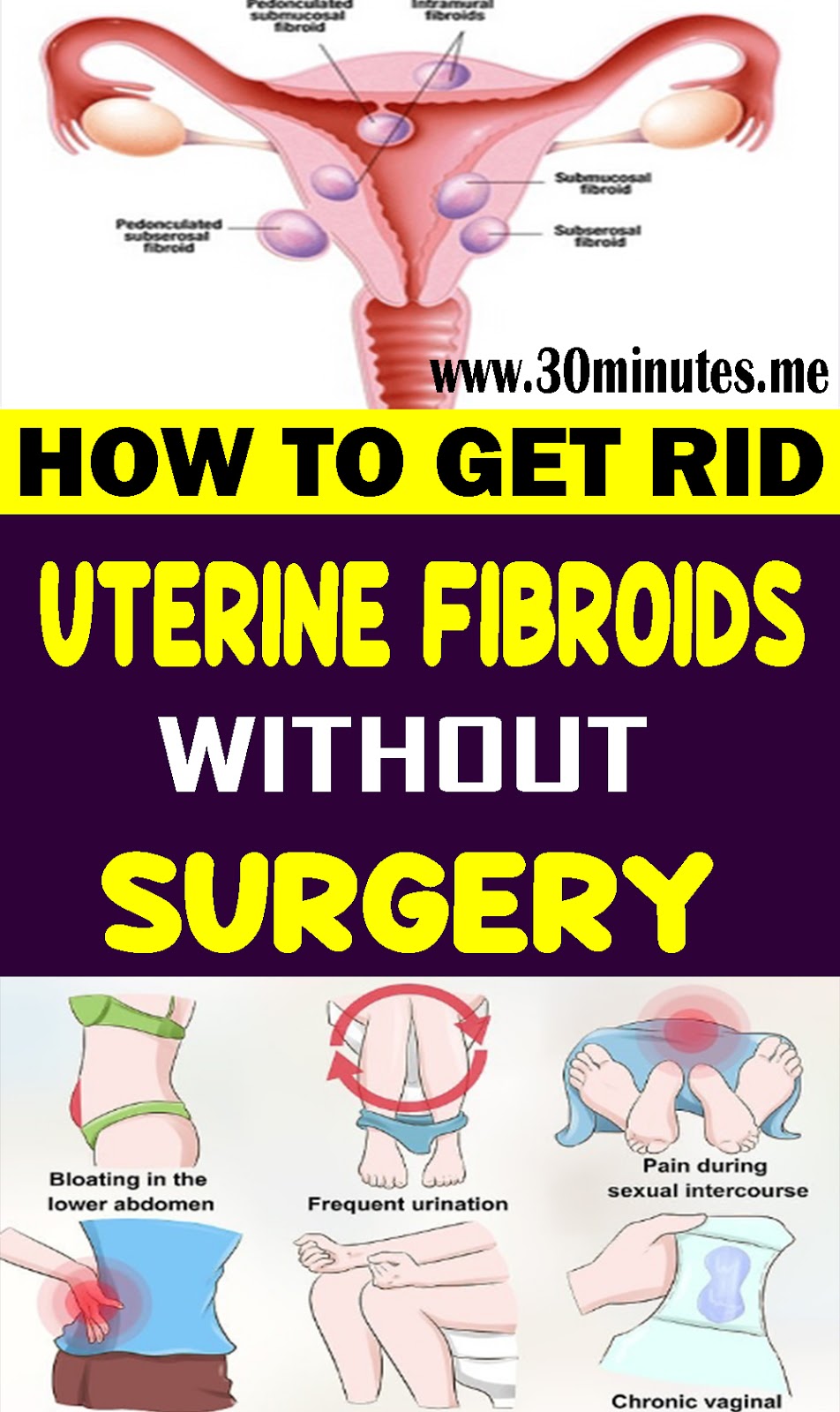 How to Get Rid of Uterine Fibroids without Surgery