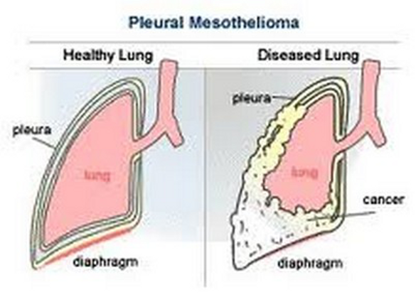 Benigni: Benign Asbestos Pleural Effusion