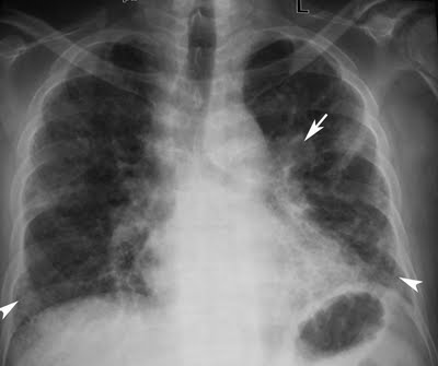 Radiodiagnosis - Imaging is Amazing-Interesting cases: Carcinoma lung ...