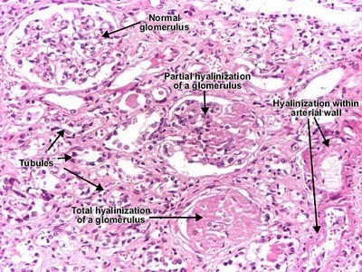 Hyaline arteriolosclerosis (Benign nephrosclerosis) Histology and ...