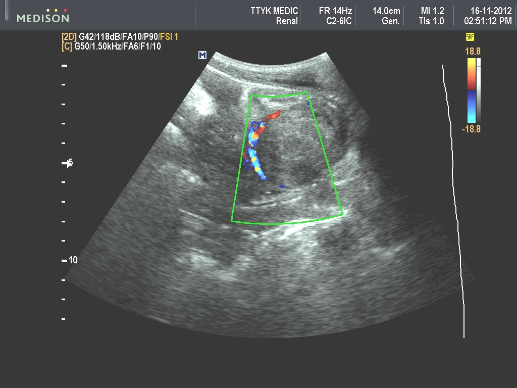 what does bladder cancer look like on ultrasound Updated