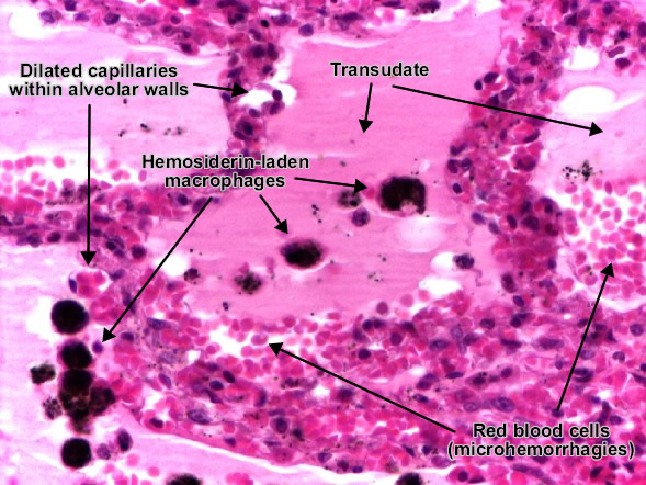 موقع الدكتور أحمد كلحى: صور باثولوجى - Pathology Slides : Pulmonary ...