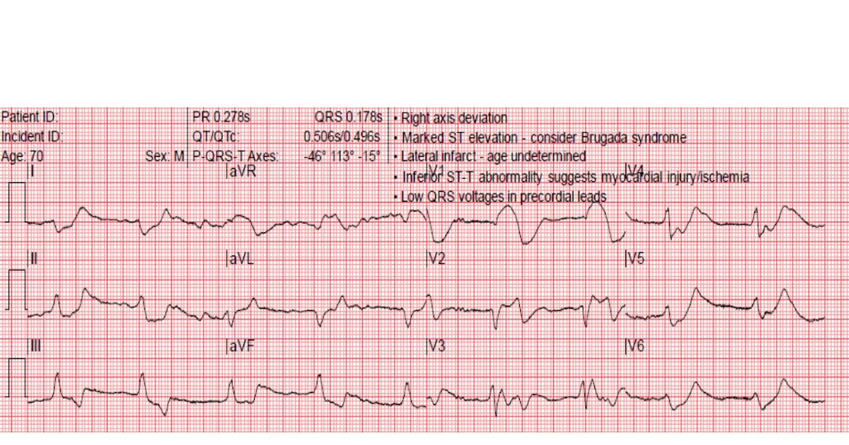 [DIAGRAM] Diagram Of Ecg - MYDIAGRAM.ONLINE