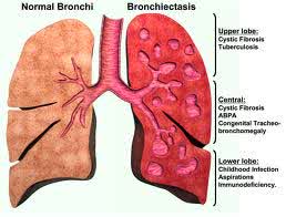 Nursing Diagnosis and Interventions for Bronchiectasis - Nursing ...