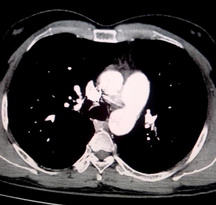 Patent ductus arteriosus-CT - Sumer's Radiology Blog