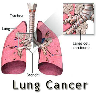 All About Cancer: Signs Of Lung Cancer