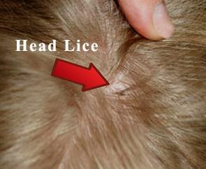 10 Effective Home Remedies for Head Lice - SkinnyZine