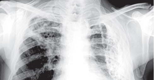 Study Medical Photos: Pleural Calcification On Chest X ray