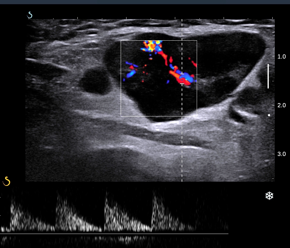 Cervical Lymph Nodes Ultrasound