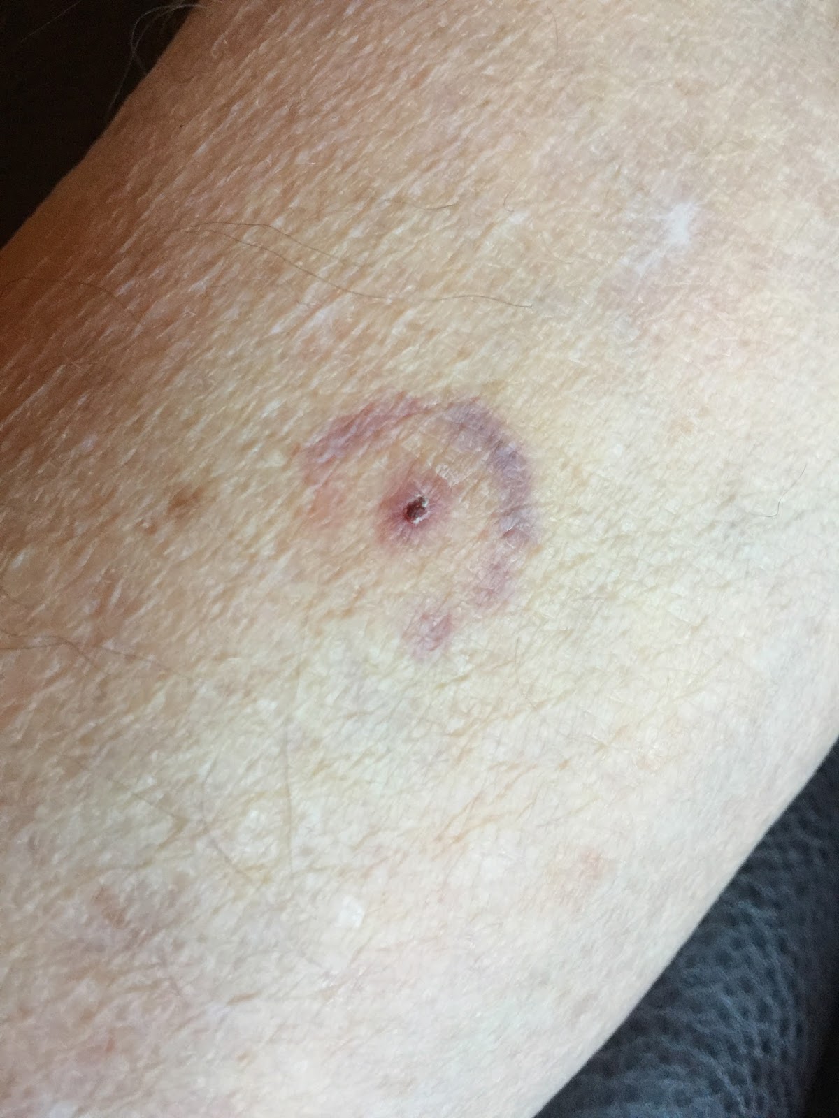 Tick Bites as related to Lyme Disease - Pictures