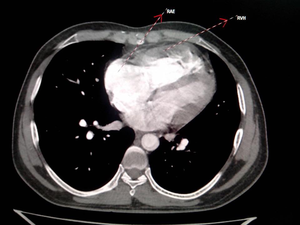 Patent ductus arteriosus-CT - Sumer's Radiology Blog