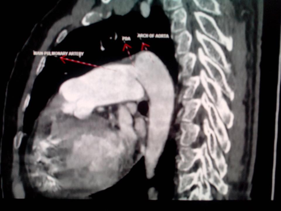 Patent ductus arteriosus-CT - Sumer's Radiology Blog