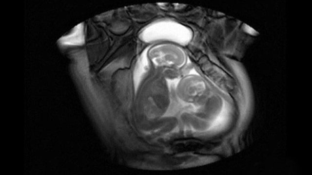 Cinematic MRI Shows Footage Of Twin Fight In The Womb