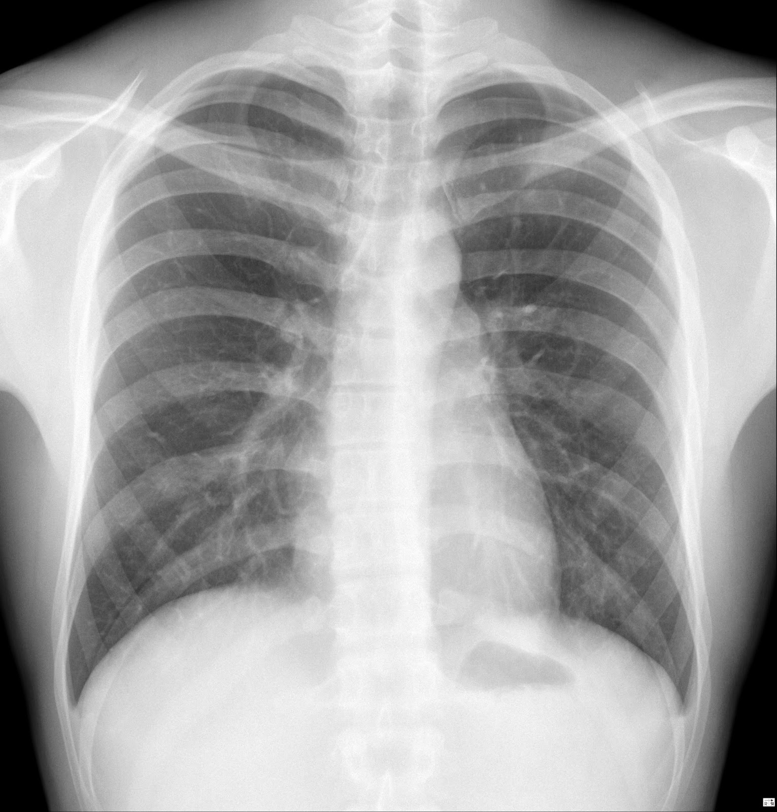 Chest X Ray - Gambaran