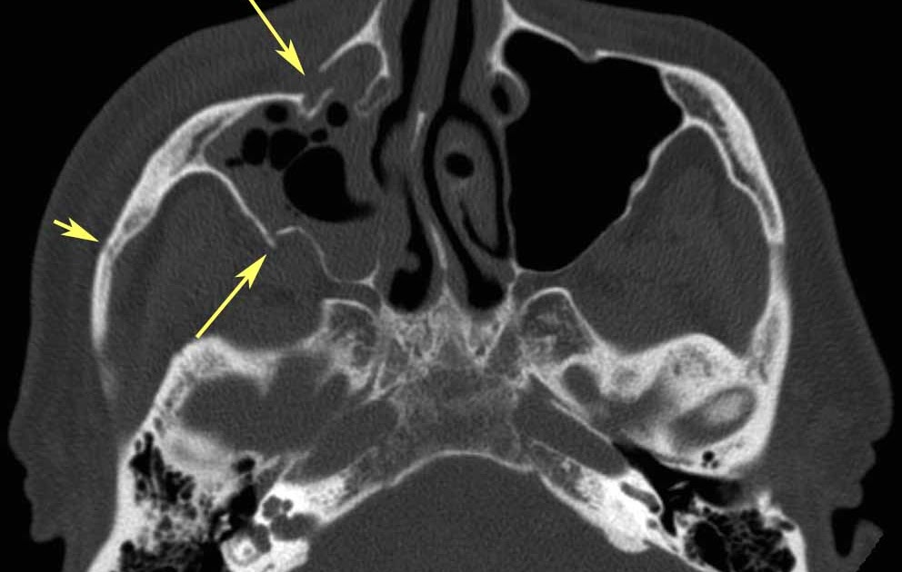 RiT radiology: Zygomaticomaxillary Complex (ZMC) Fracture image.