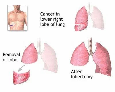 Tumor - Lobectomy Treatment Service Provider from Thrissur