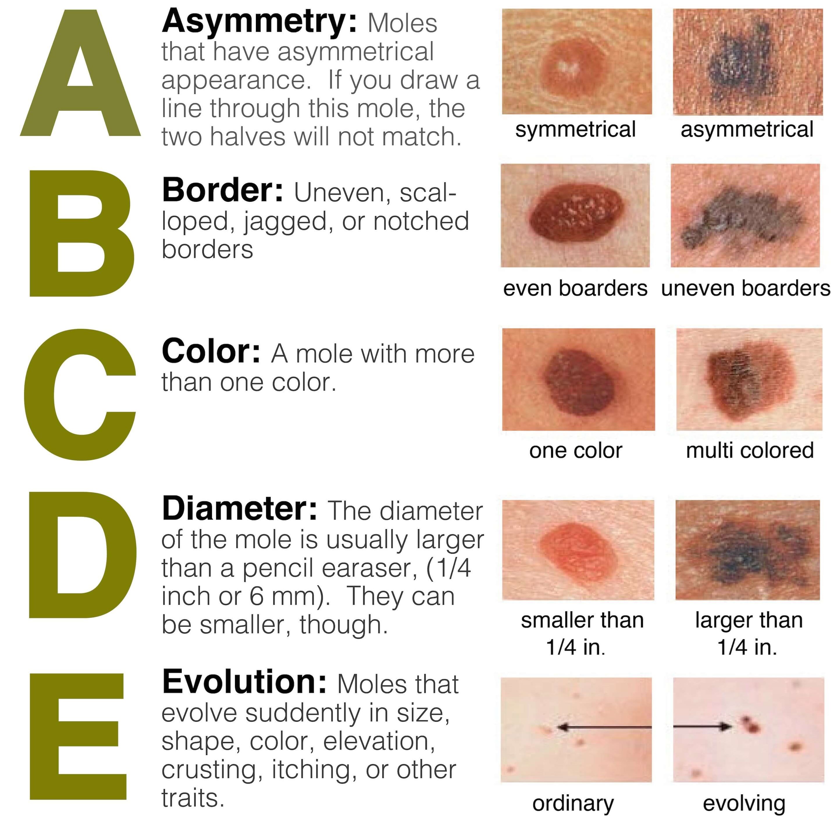 Abcde Melanoma Test Hand Out