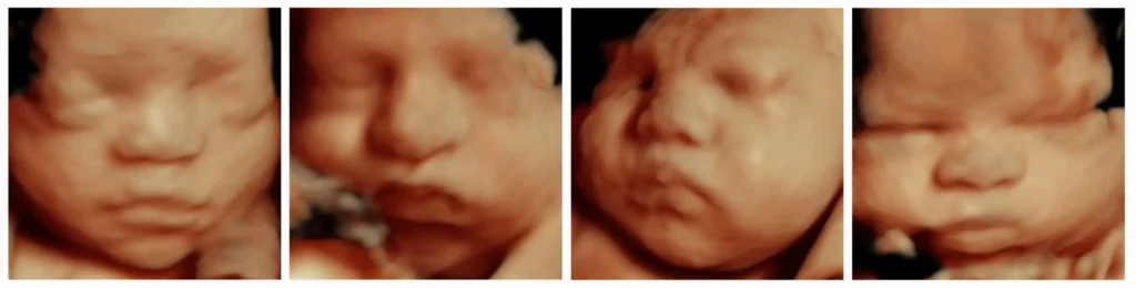 5D ultrasound for pregnant women to see their baby. 3D 4D ultrasounds