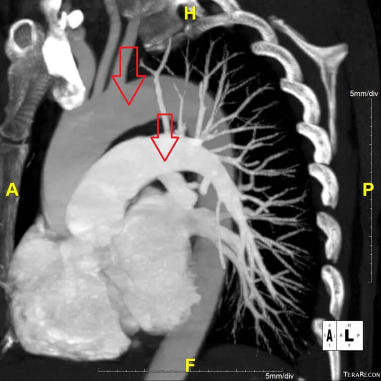 Transposition Of The Great Arteries X Ray